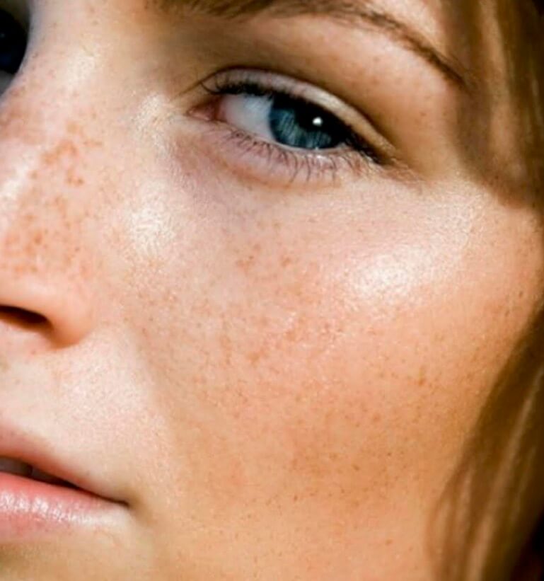 Skin Cleanse Image - a close-up of a woman's face. She has freckles on clear, smooth skin